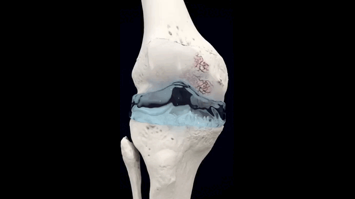 Osteomed PHOTO